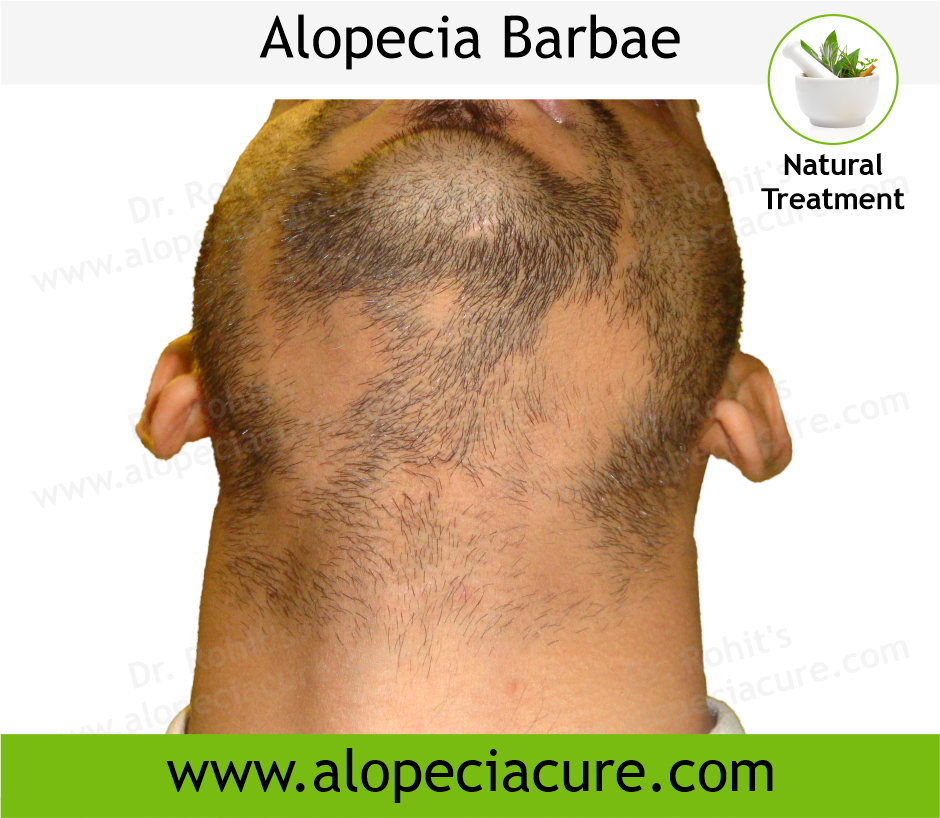 Primary Alopecia Areata